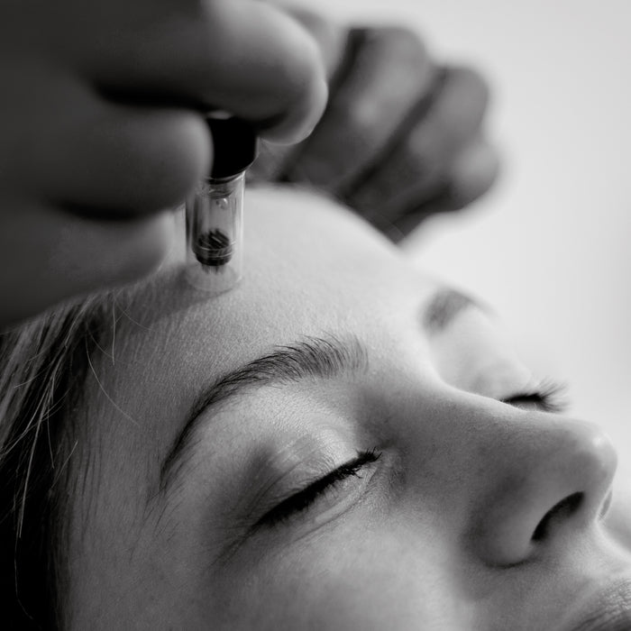 SkinPen® Microneedling (60 minutes)
